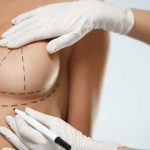 Breast lift surgery in Delhi