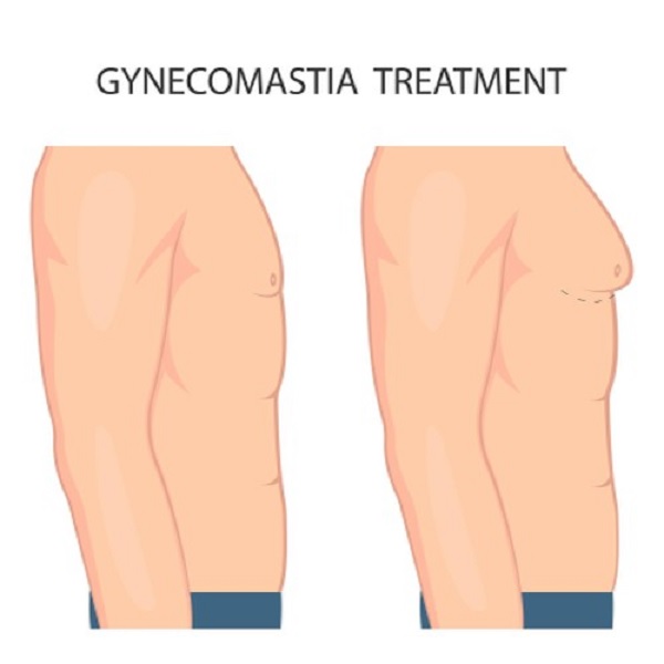 gynecomastia surgery in Delhi